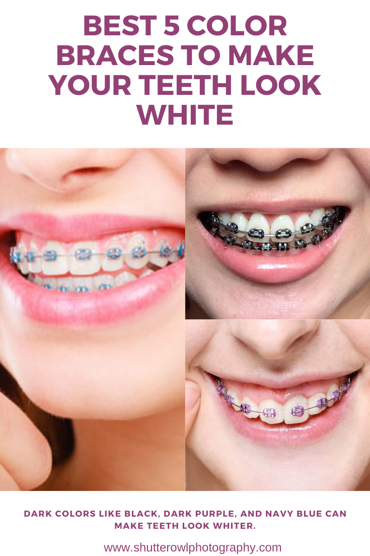 braces colors for whiter teeth